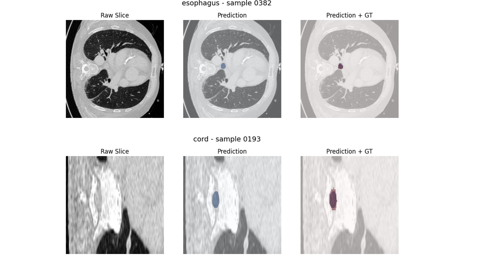 Esophagus and Spinal Cord Segmentation Results